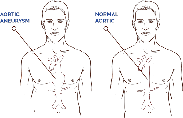 Aortic Aneurysm Diagram